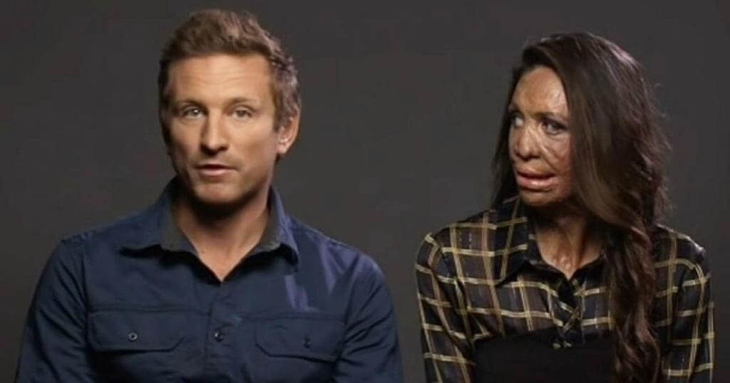 Su esposo no abandona a su pareja después de que un incendio dañe su aspecto físico, demuestra lo que es el verdadero compromiso￼