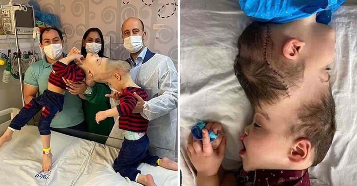 Gemelos brasileños unidos por su cerebro, tuvieron la cirugía que tanto necesitaban