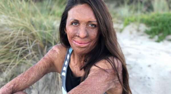 Turia Pitt.
