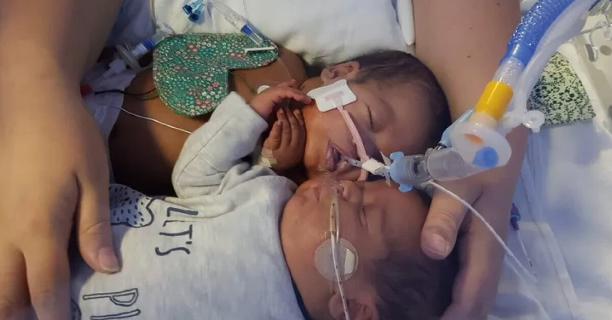 ¡Un verdadero milagro! Conoce la historia del bebé que salvó a su gemelo poco tiempo después de nacer