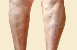 Incluye en tu dieta los 6 alimentos que combaten las várices y cuidan tu circulación