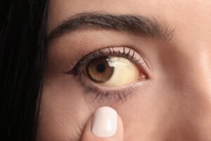 "Me dolía mucho y lo tengo reventado": la historia de una joven que podría perder un ojo por mal uso de lentillas